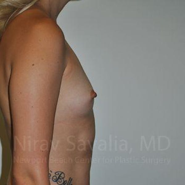 Chin Implants Before & After Gallery - Patient 1655595 - Before