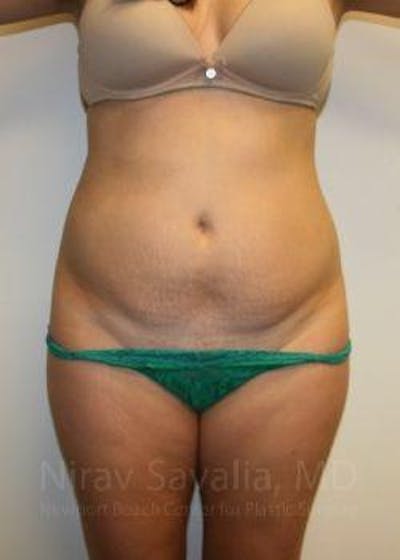 Oncoplastic Reconstruction Before & After Gallery - Patient 1655598 - Before