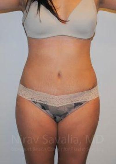 Liposuction Before & After Gallery - Patient 1655598 - After