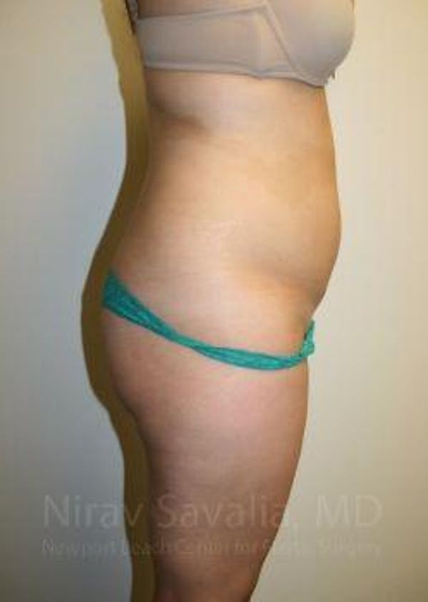 Abdominoplasty Tummy Tuck Before & After Gallery - Patient 1655598 - Before
