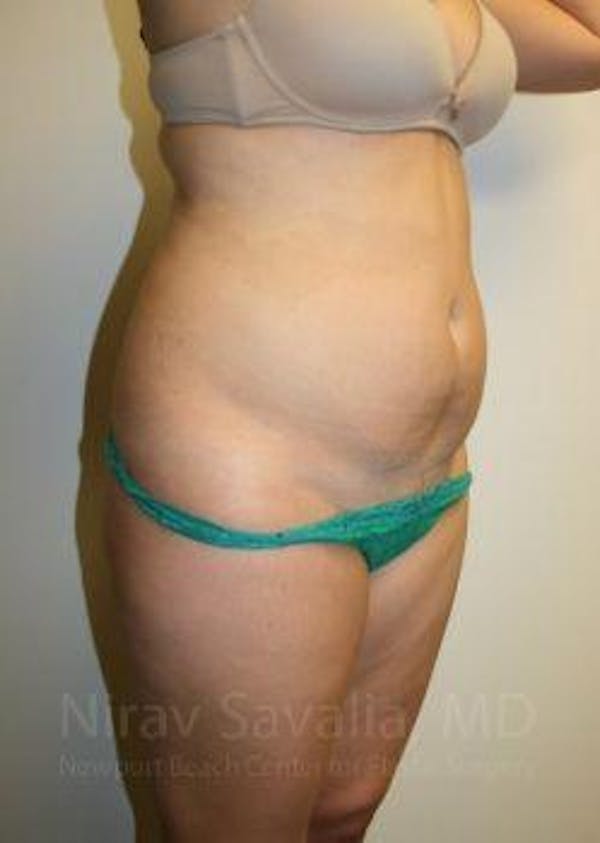 Breast Explantation En Bloc Capsulectomy Before & After Gallery - Patient 1655598 - Before