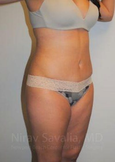 Thigh Lift Before & After Gallery - Patient 1655598 - After