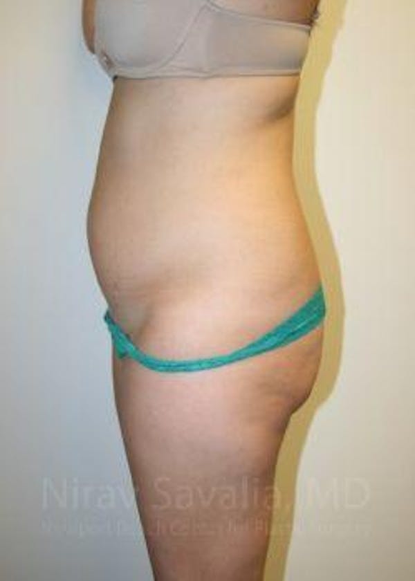 Mastectomy Reconstruction Before & After Gallery - Patient 1655598 - Before