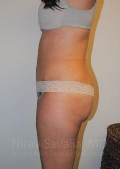 Breast Reduction Before & After Gallery - Patient 1655598 - After