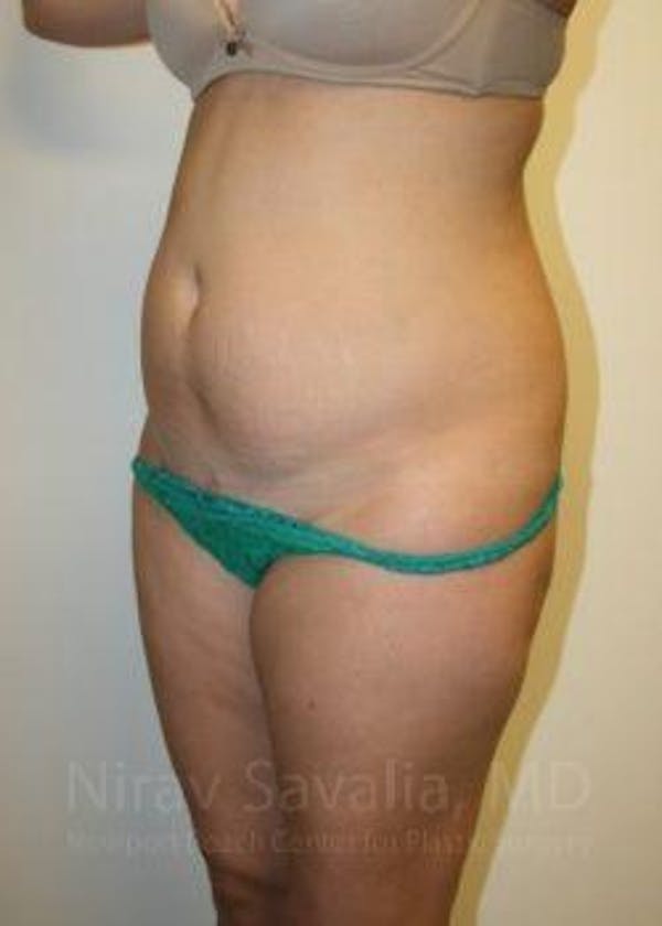 Abdominoplasty Tummy Tuck Before & After Gallery - Patient 1655598 - Before