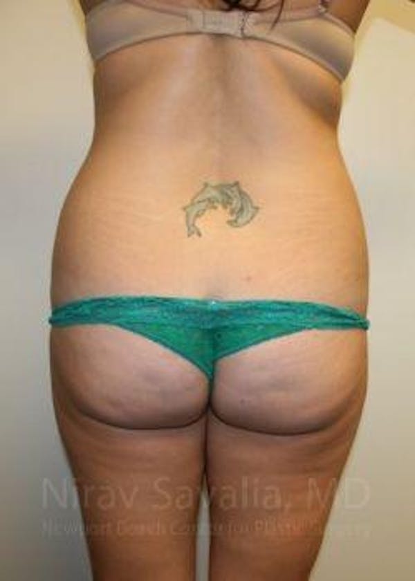 Thigh Lift Before & After Gallery - Patient 1655598 - Before