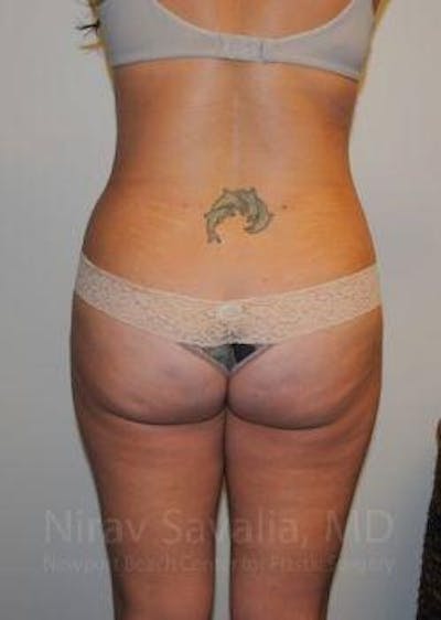 Thigh Lift Before & After Gallery - Patient 1655598 - After