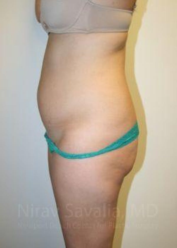 Abdominoplasty Tummy Tuck Before & After Gallery - Patient 1655599 - Before