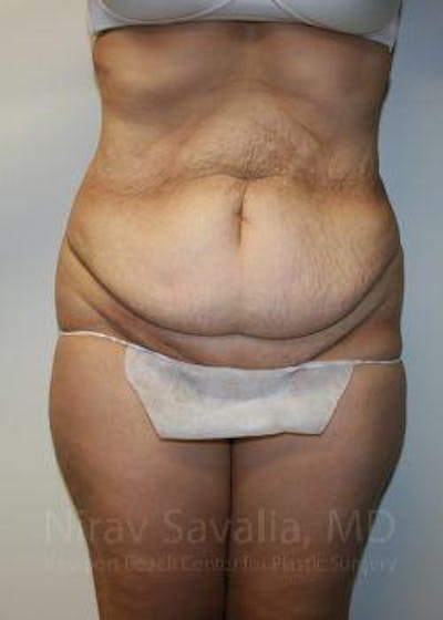 Oncoplastic Reconstruction Before & After Gallery - Patient 1655601 - Before