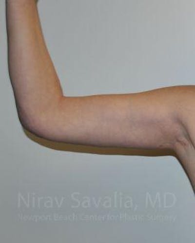 Thigh Lift Before & After Gallery - Patient 1655600 - After