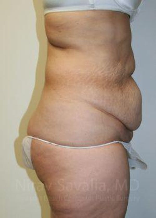 Body Contouring after Weight Loss Before & After Gallery - Patient 1655601 - Before