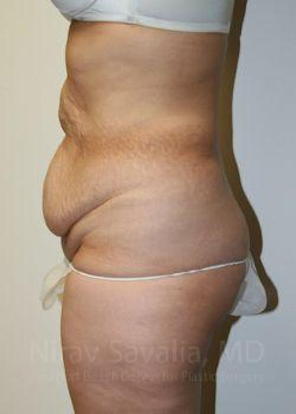 Breast Lift without Implants Before & After Gallery - Patient 1655601 - Before