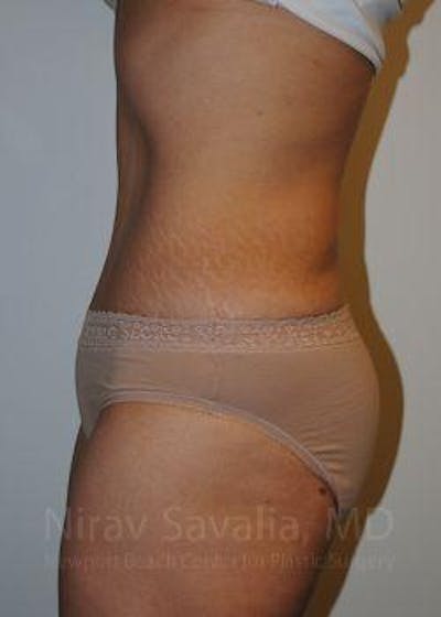 Thigh Lift Before & After Gallery - Patient 1655601 - After