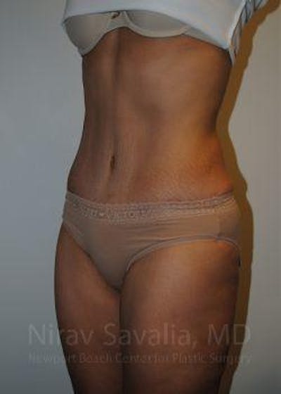 Thigh Lift Before & After Gallery - Patient 1655601 - After