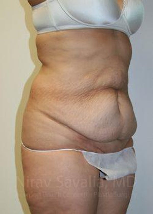 Body Contouring after Weight Loss Before & After Gallery - Patient 1655601 - Before
