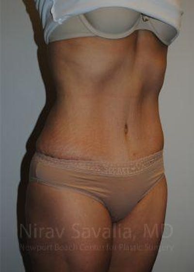 Mastectomy Reconstruction Before & After Gallery - Patient 1655601 - After