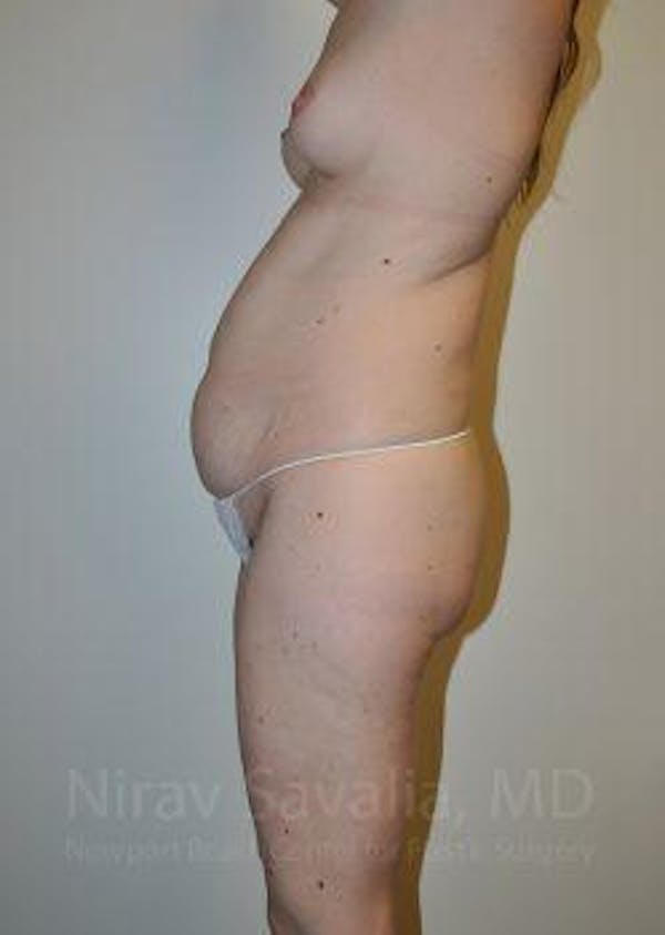Oncoplastic Reconstruction Before & After Gallery - Patient 1655603 - Before