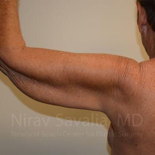 Liposuction Before & After Gallery - Patient 1655602 - Before