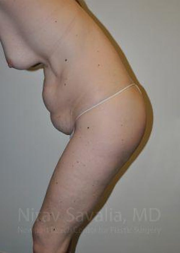 Oncoplastic Reconstruction Before & After Gallery - Patient 1655603 - Before