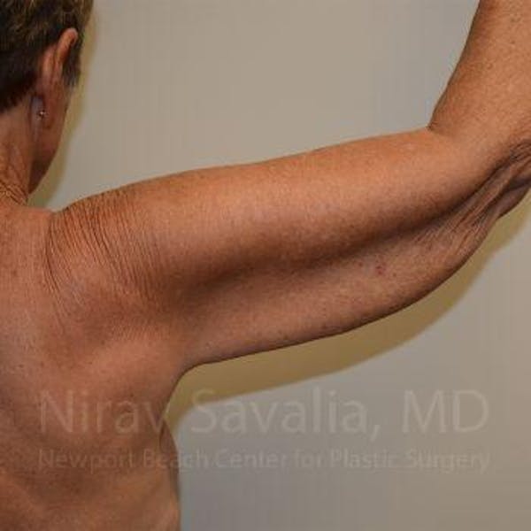 Mastectomy Reconstruction Before & After Gallery - Patient 1655602 - Before