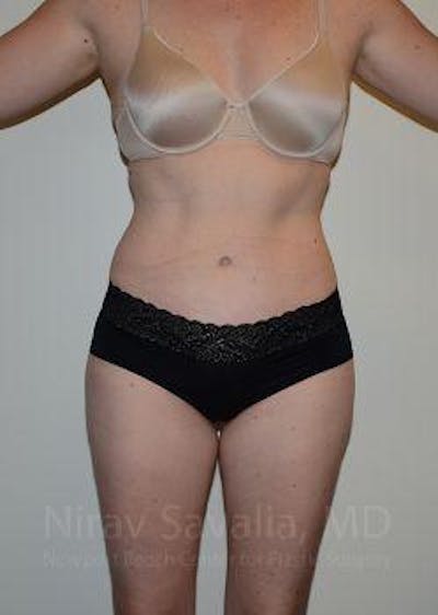 Thigh Lift Before & After Gallery - Patient 1655605 - After