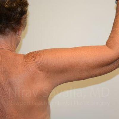 Mastectomy Reconstruction Before & After Gallery - Patient 1655602 - After