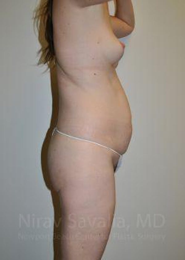 Breast Explantation En Bloc Capsulectomy Before & After Gallery - Patient 1655605 - Before