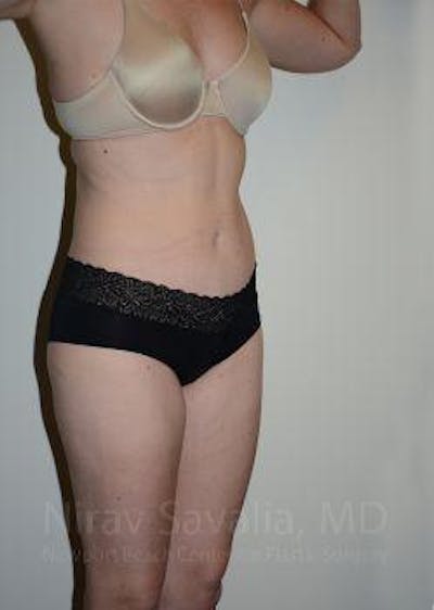 Breast Explantation En Bloc Capsulectomy Before & After Gallery - Patient 1655603 - After