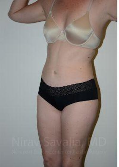 Mastectomy Reconstruction Before & After Gallery - Patient 1655605 - After