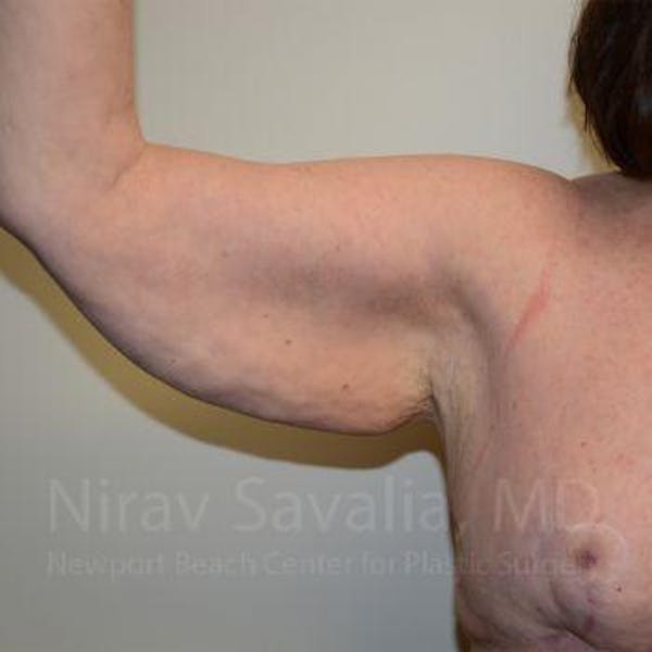 Liposuction Before & After Gallery - Patient 1655606 - Before