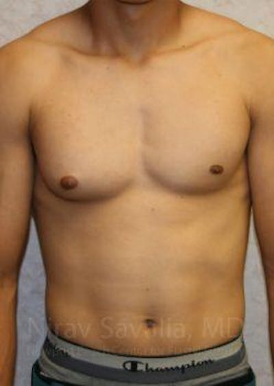 Liposuction Before & After Gallery - Patient 1655607 - Before