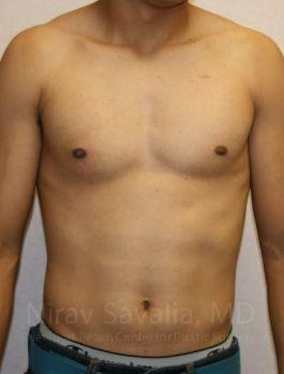 Breast Explantation En Bloc Capsulectomy Before & After Gallery - Patient 1655607 - After