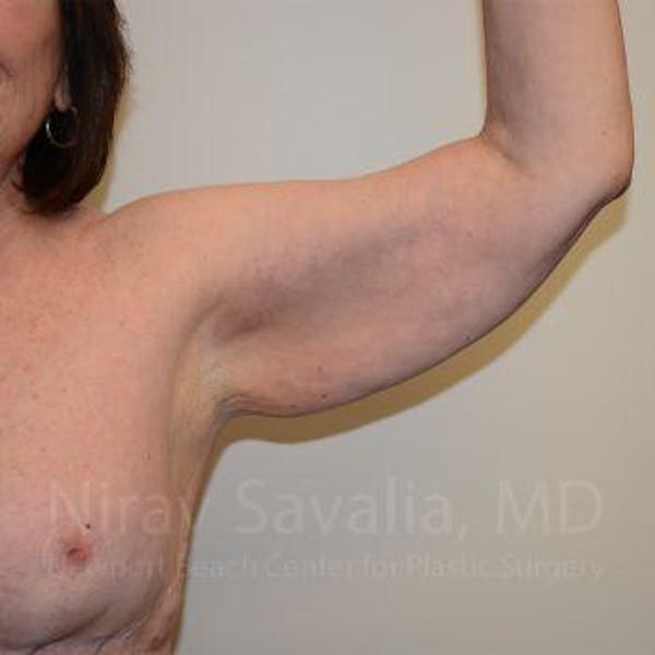 Mastectomy Reconstruction Before & After Gallery - Patient 1655606 - Before
