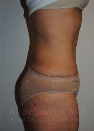 Thigh Lift Before & After Gallery - Patient 1655608 - After