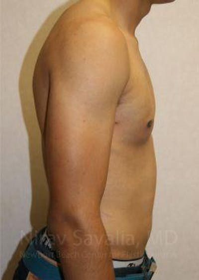 Breast Explantation En Bloc Capsulectomy Before & After Gallery - Patient 1655607 - After