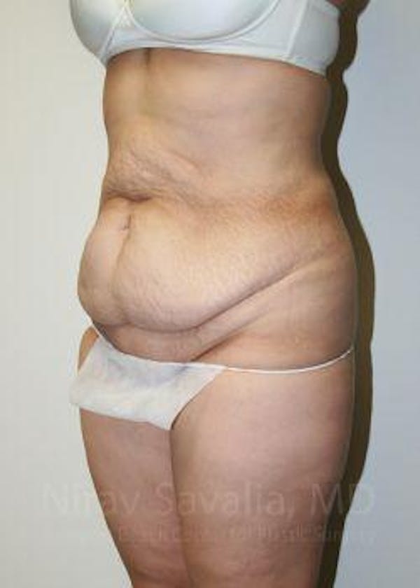 Body Contouring after Weight Loss Before & After Gallery - Patient 1655608 - Before