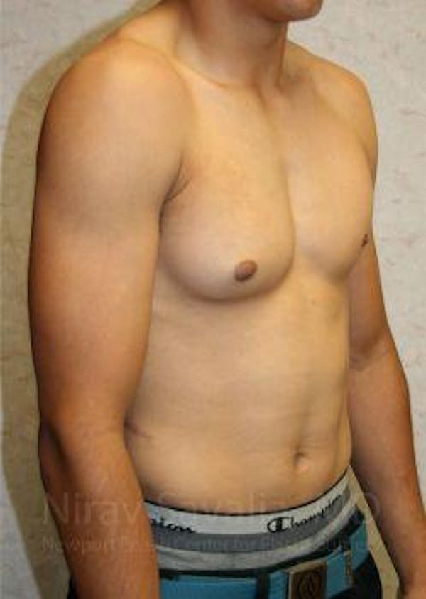 Liposuction Before & After Gallery - Patient 1655607 - Before