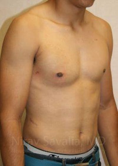 Liposuction Before & After Gallery - Patient 1655607 - After