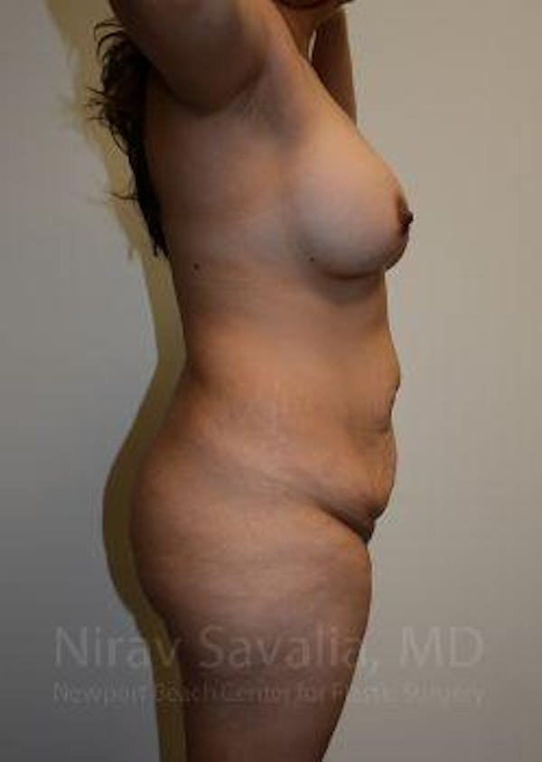 Oncoplastic Reconstruction Before & After Gallery - Patient 1655609 - Before