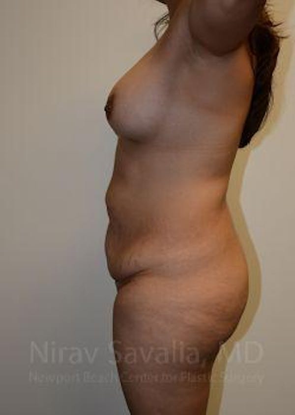 Breast Reduction Before & After Gallery - Patient 1655609 - Before