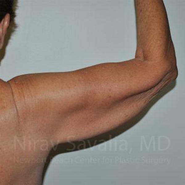 Mastectomy Reconstruction Before & After Gallery - Patient 1655610 - Before