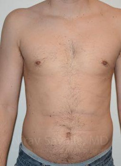 Breast Reduction Before & After Gallery - Patient 1655612 - After