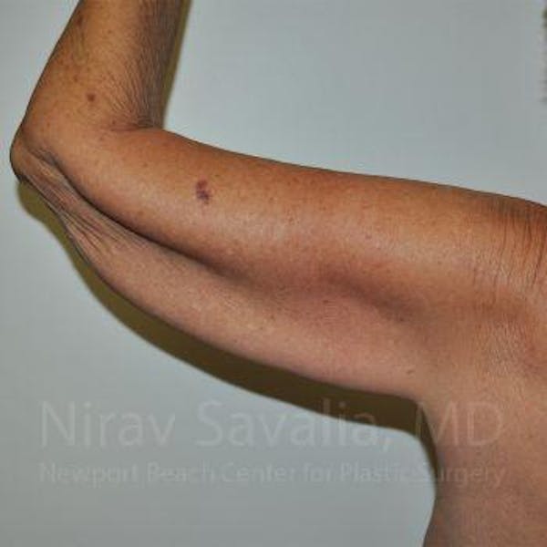 Oncoplastic Reconstruction Before & After Gallery - Patient 1655610 - Before