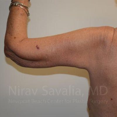 Oncoplastic Reconstruction Before & After Gallery - Patient 1655610 - After