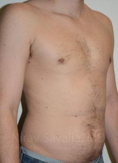 Mastectomy Reconstruction Before & After Gallery - Patient 1655612 - After