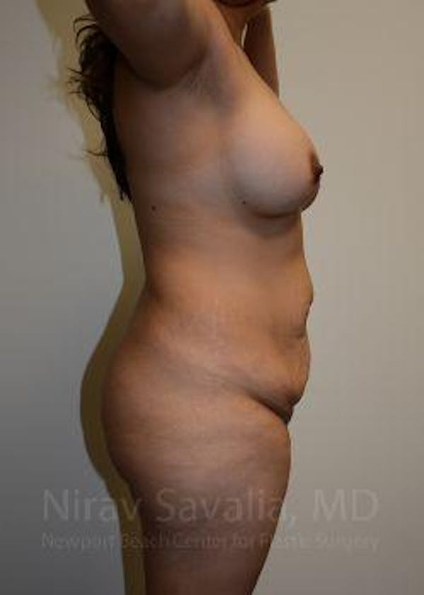 Breast Explantation En Bloc Capsulectomy Before & After Gallery - Patient 1655613 - Before