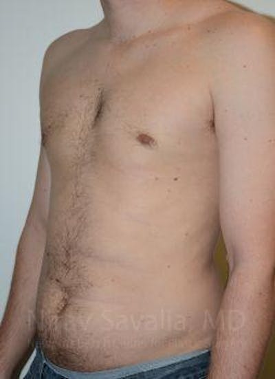 Mastectomy Reconstruction Before & After Gallery - Patient 1655612 - After