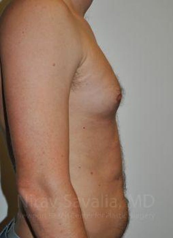 Chin Implants Before & After Gallery - Patient 1655612 - Before