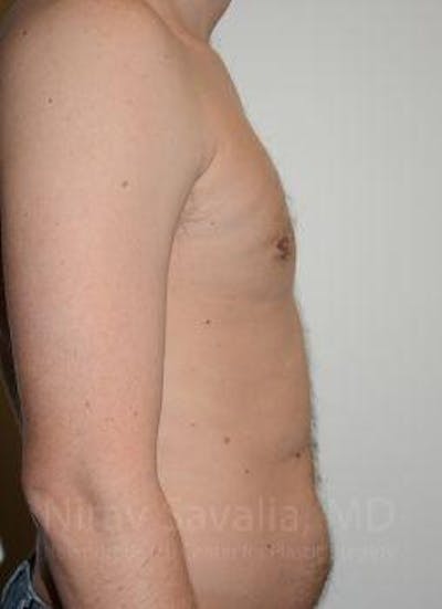 Breast Explantation En Bloc Capsulectomy Before & After Gallery - Patient 1655612 - After