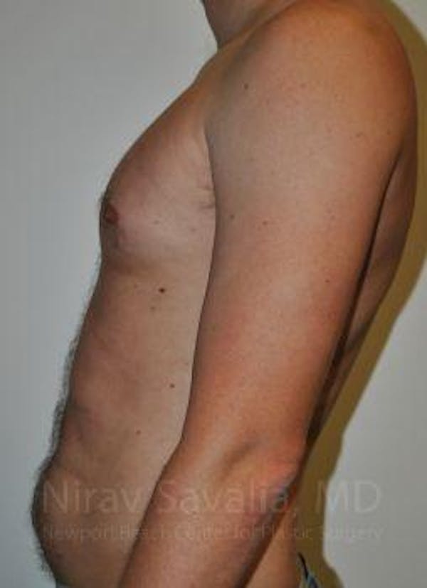 Breast Explantation En Bloc Capsulectomy Before & After Gallery - Patient 1655612 - Before